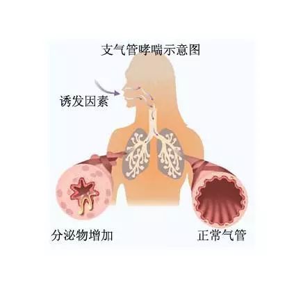 支气管哮喘，全面认识、深度理解与管理之道