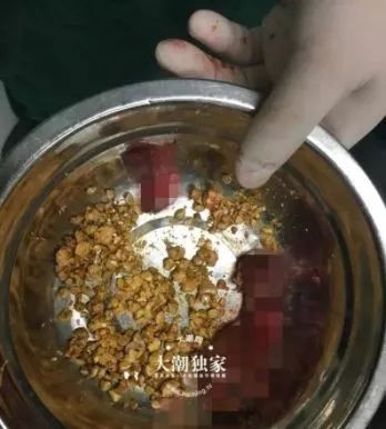 吃播是否会引发胆结石？