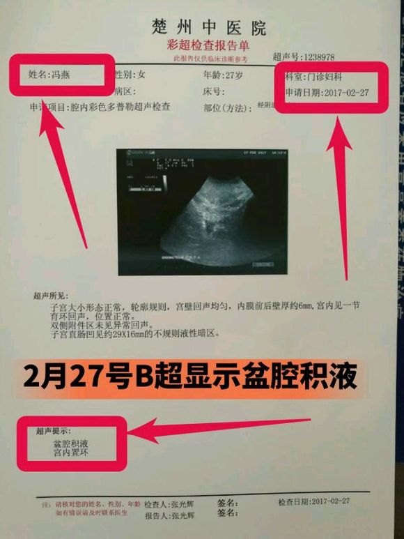 如何应对产后盆腔积液和宫腔积液的挑战