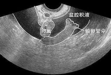 盆腔积液解析，成因、严重程度及应对之道