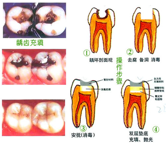 龋齿牙详解，图片展示、预防与治疗方法